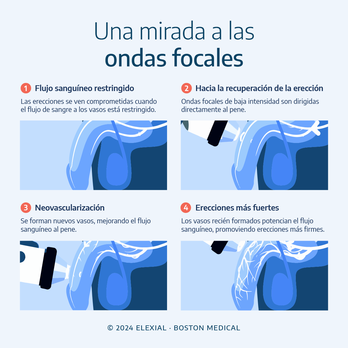 Ilustración sobre una mirada a las ondas focales para la disfuncion erectil